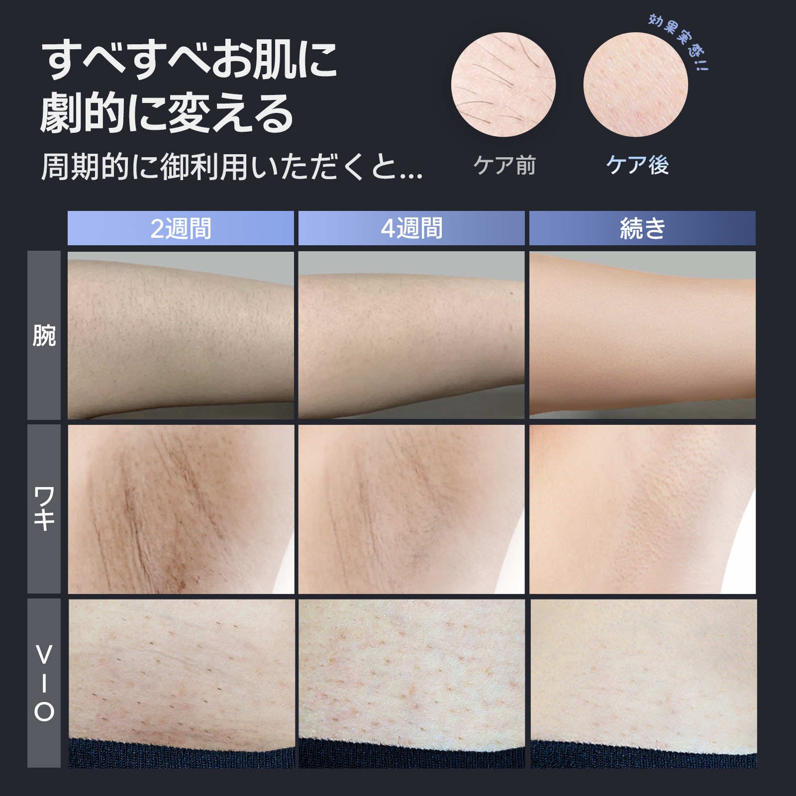 Ulike Air 2 Men 髭脱毛器・家庭用脱毛器・脱毛器・メンズ剛毛脱毛器・メンズレーザー脱毛器