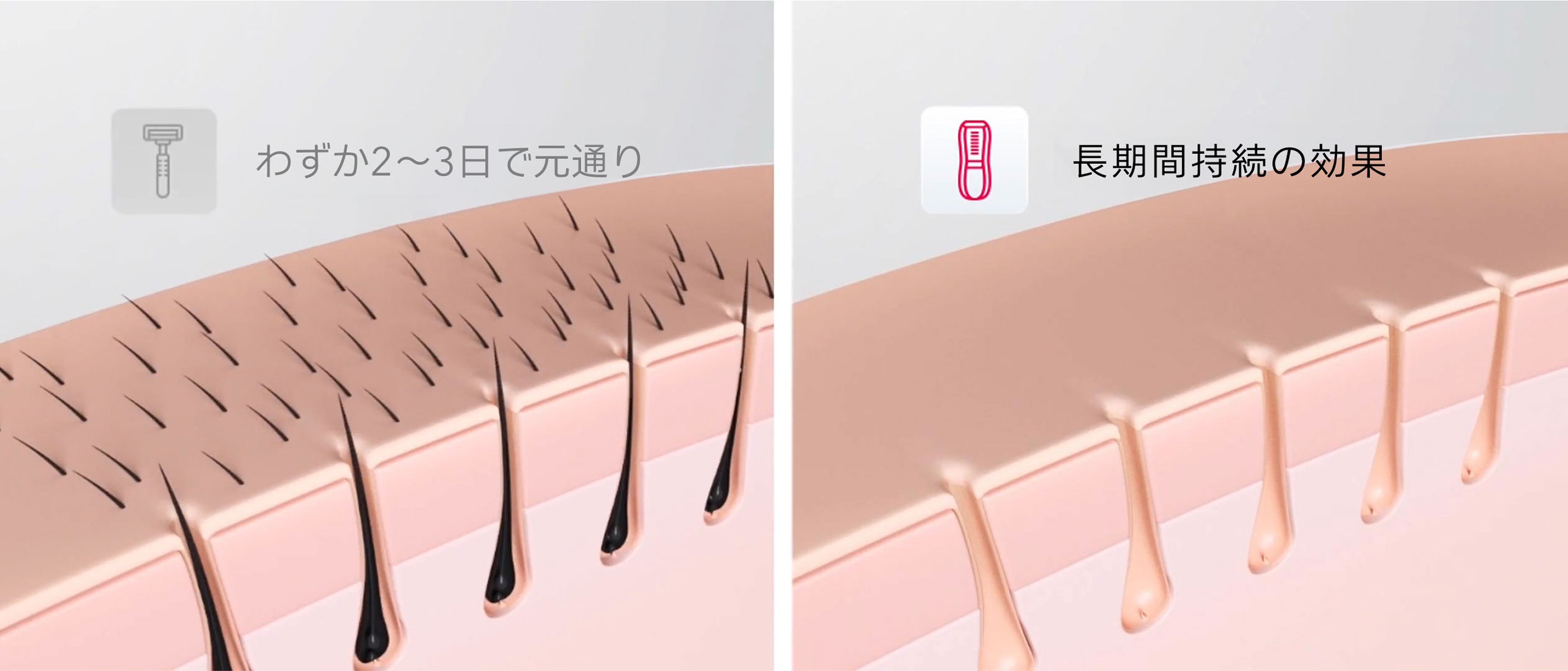 公式】Ulike（ユーライク）脱毛器・ 光美容器のIPL技術について｜脱毛